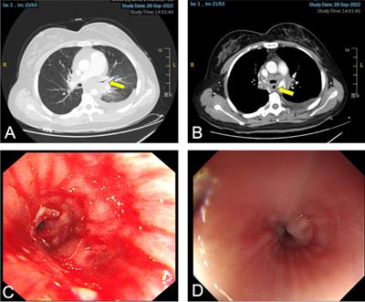 Case report: A case of recurrent cervical cancer with bronchial and esophageal metastases presenting with hemoptysis and dysphagia